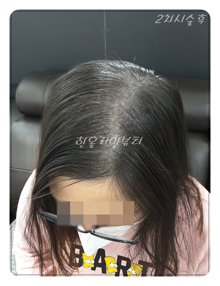 인천두피문신