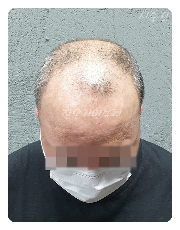 smp두피문신