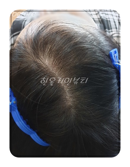 압구정두피문신
