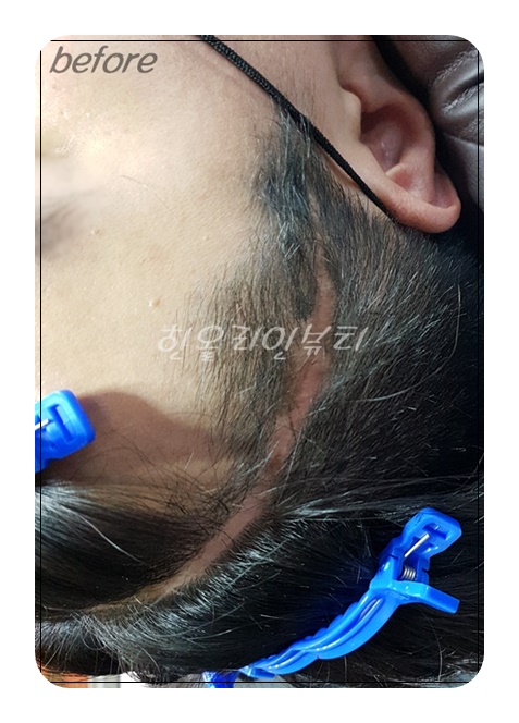 서울두피문신