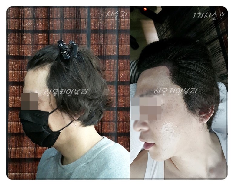 두피부작용