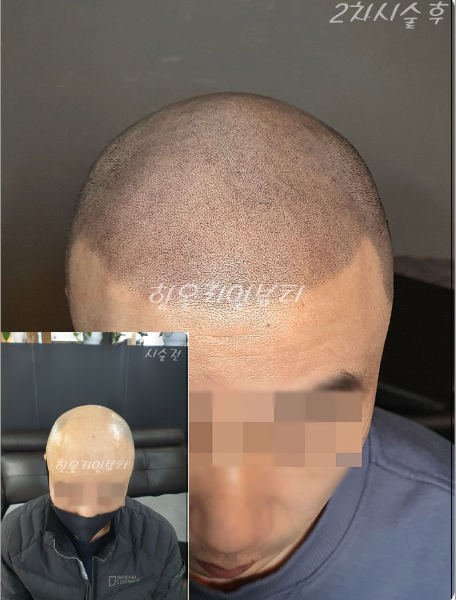 일산두피문신
