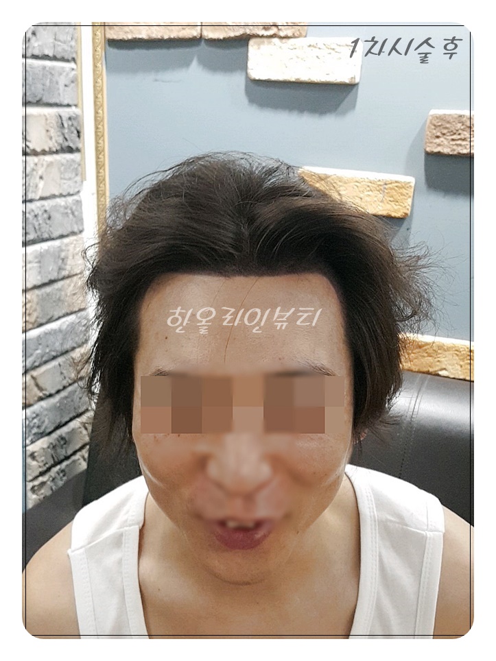 남성두피문신
