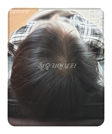 강남두피문신