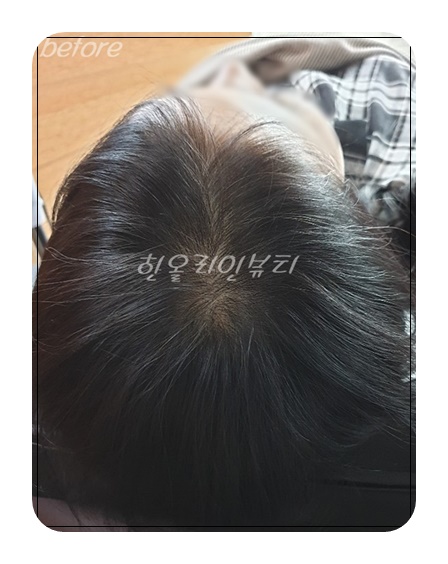 정수리두피문신