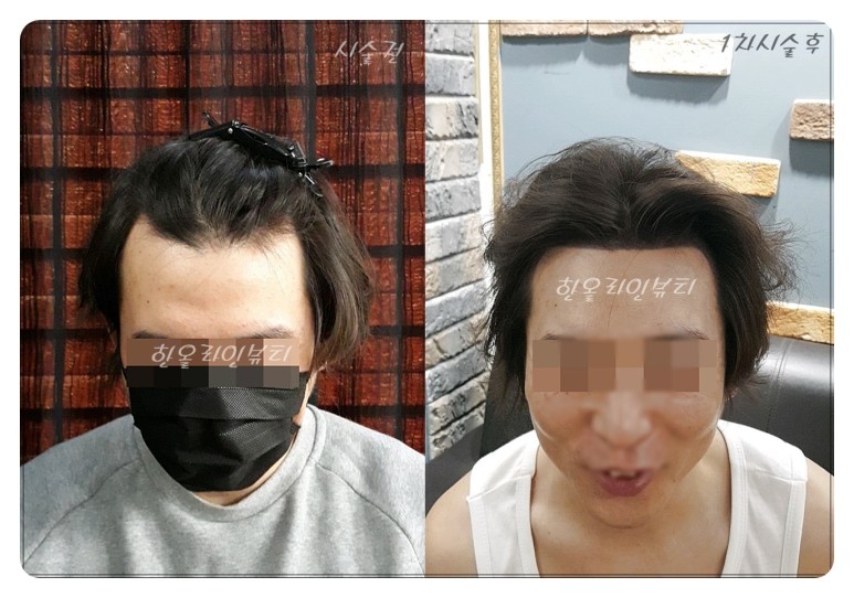 밀도보강
