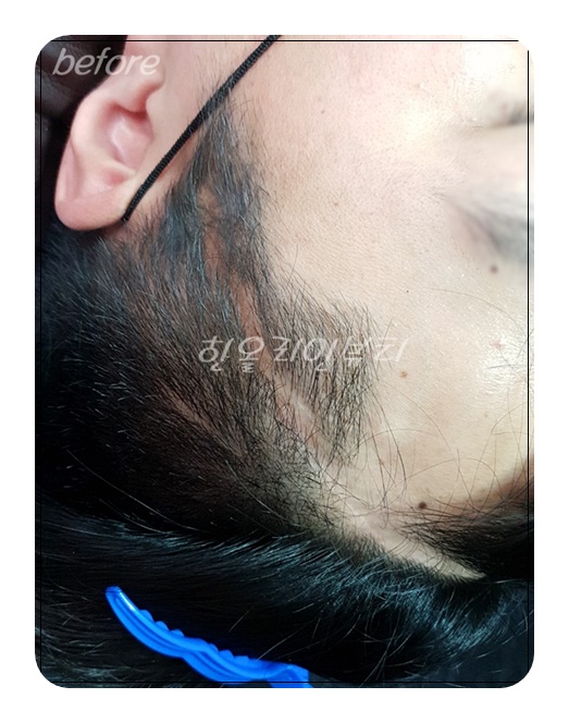 신월두피문신