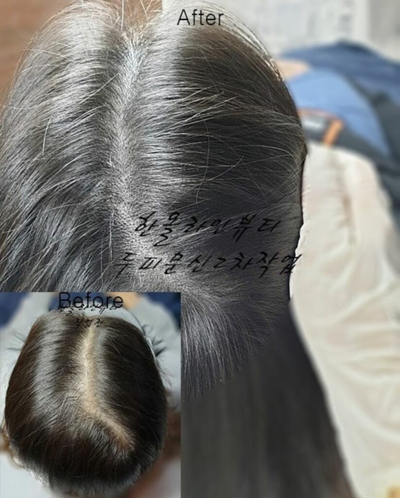 김포두피문신
