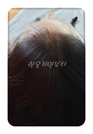 여성두피문신