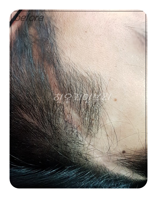 신정두피문신