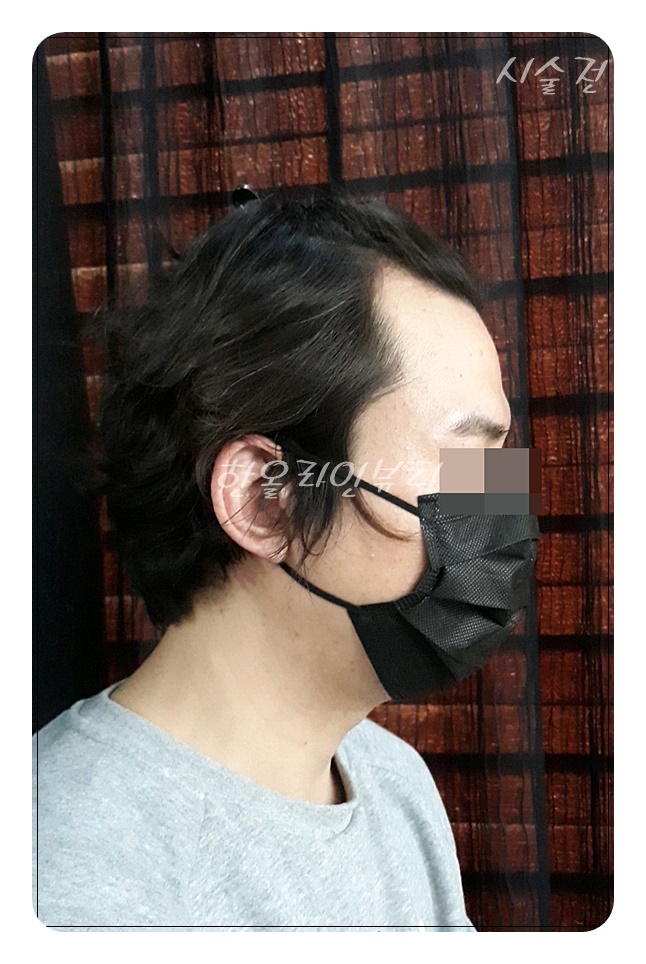 탈모커버