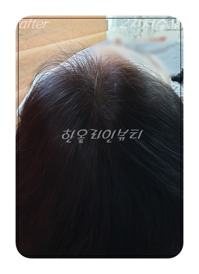 헤어라인문신