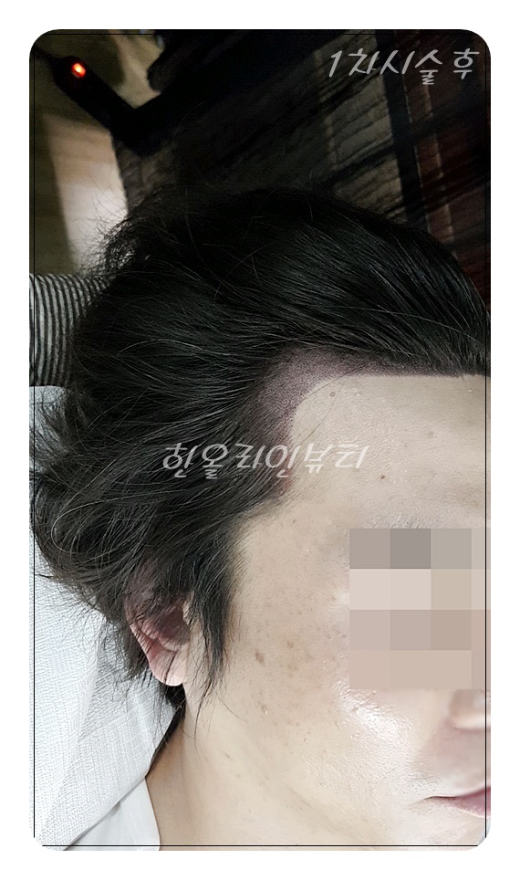 두피문신