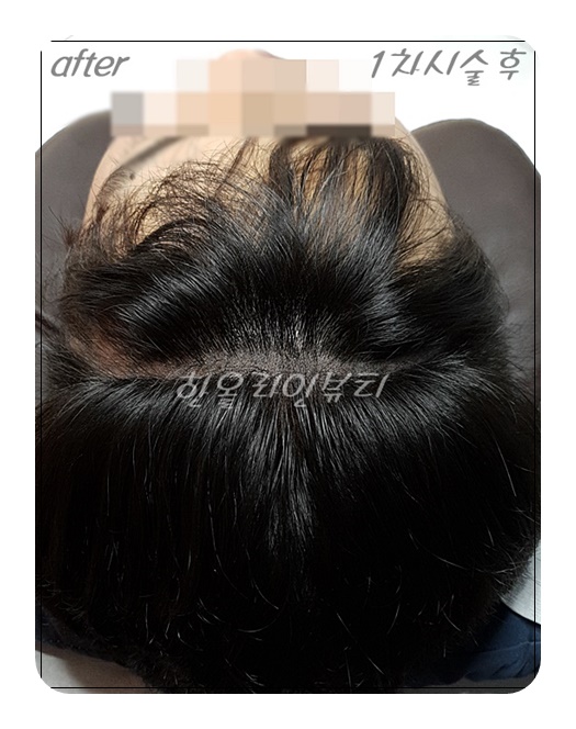 여의도두피문신