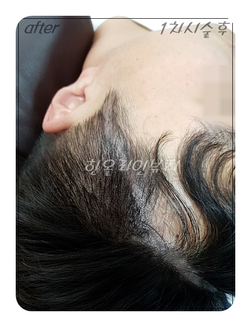 홍대두피문신