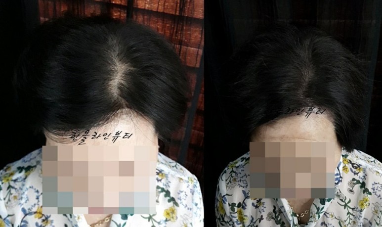 smp두피문신
