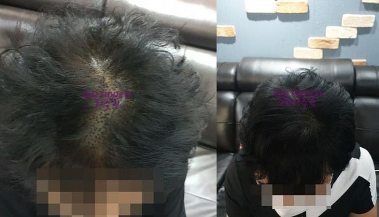 잘못되어진 두피문신 커버

