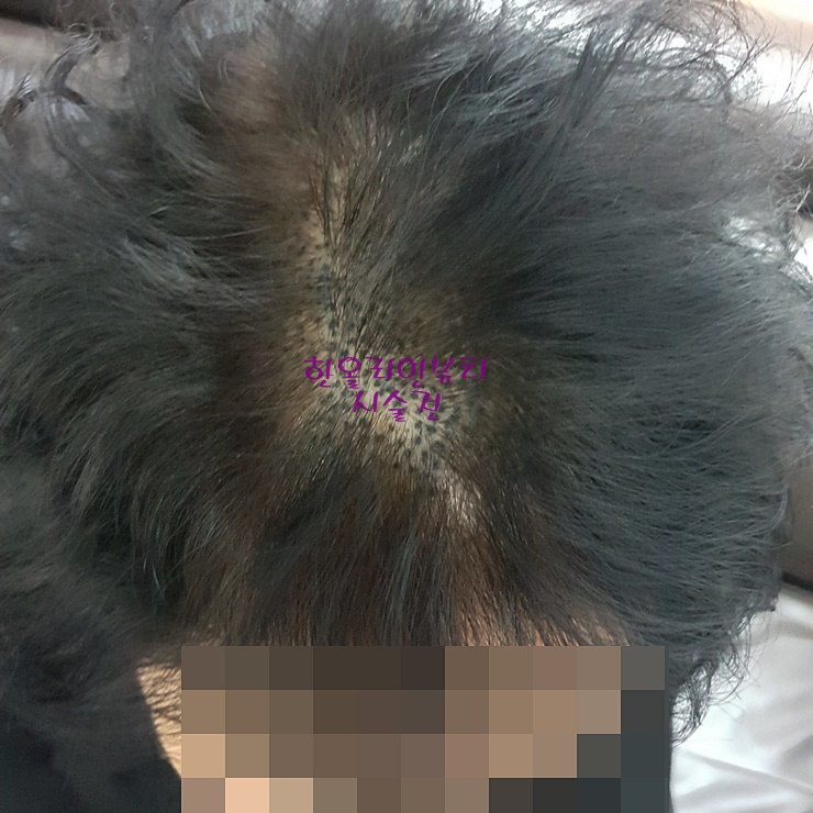 잘못된두피문신