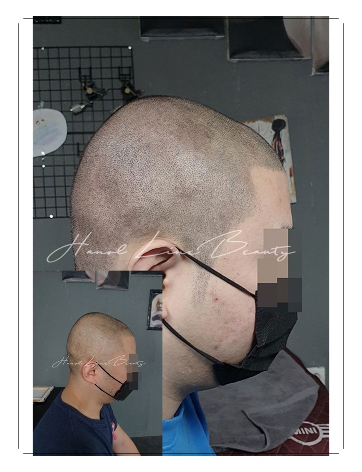 장기동두피문신