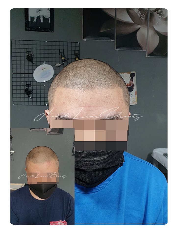 smp두피문신