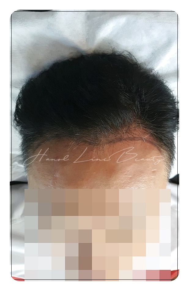 일산두피문신