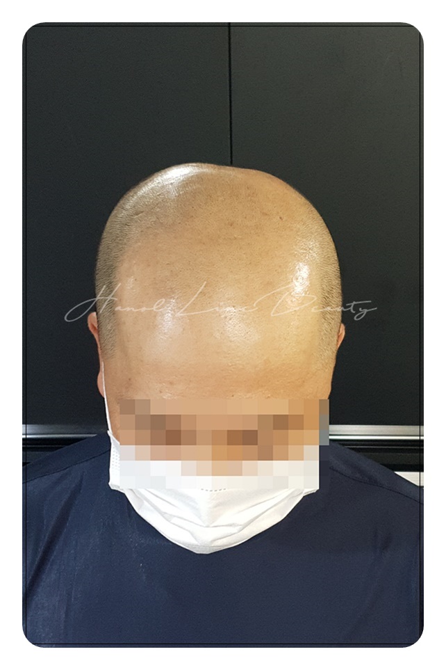 김포두피문신