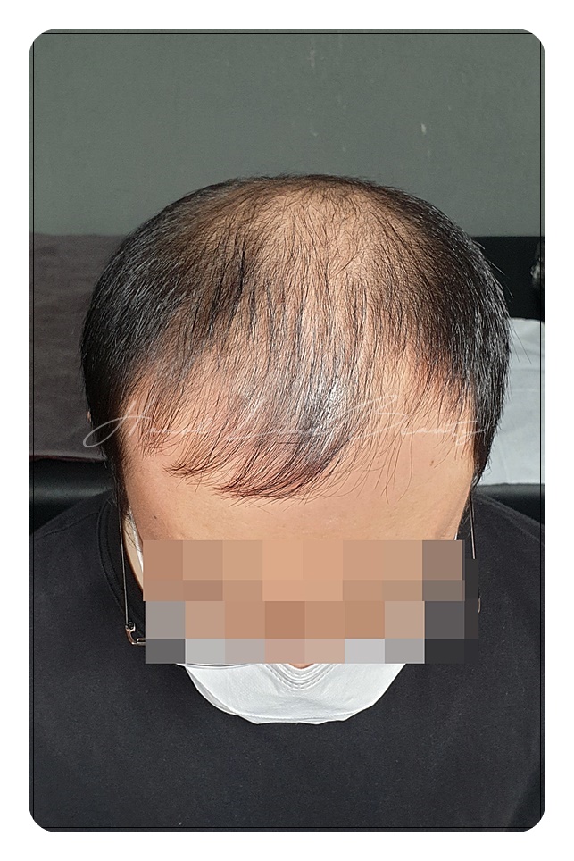 일산두피문신