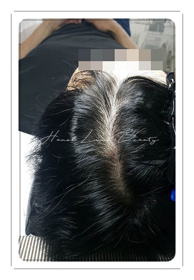 일산두피문신