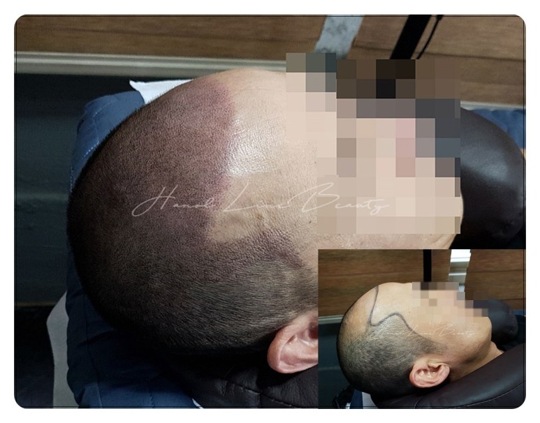 운양동두피문신