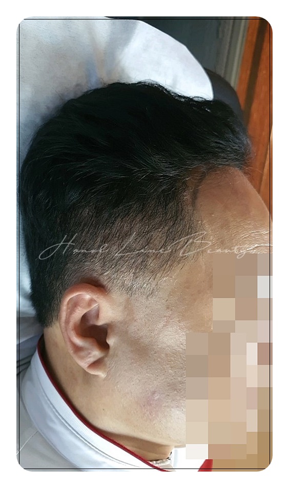 smp두피문신