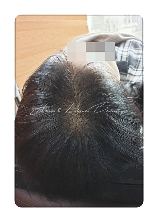 여성탈모커버