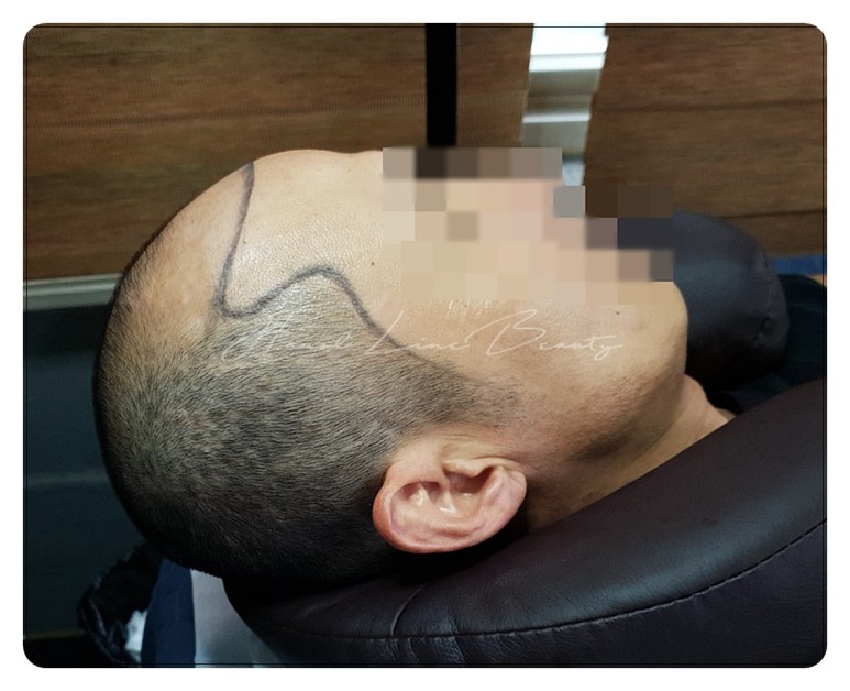 김포smp두피문신
