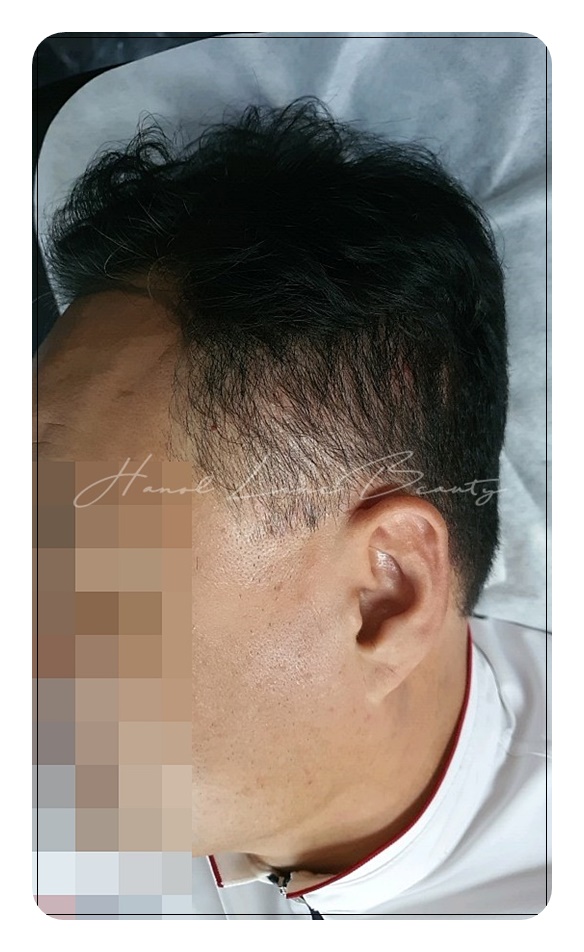 일산두피문신