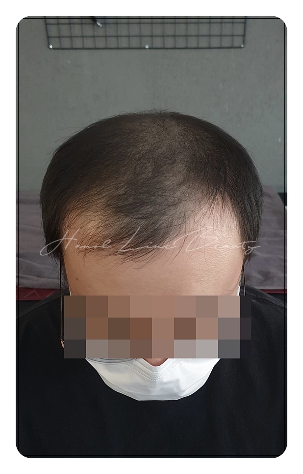 일산두피타투