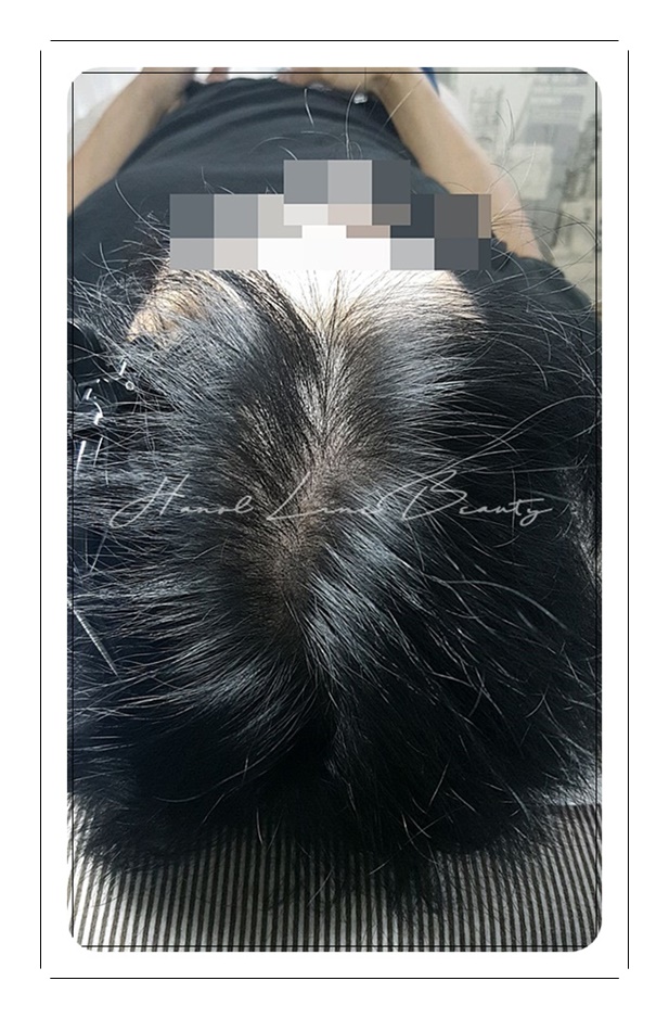 두피밀도보강