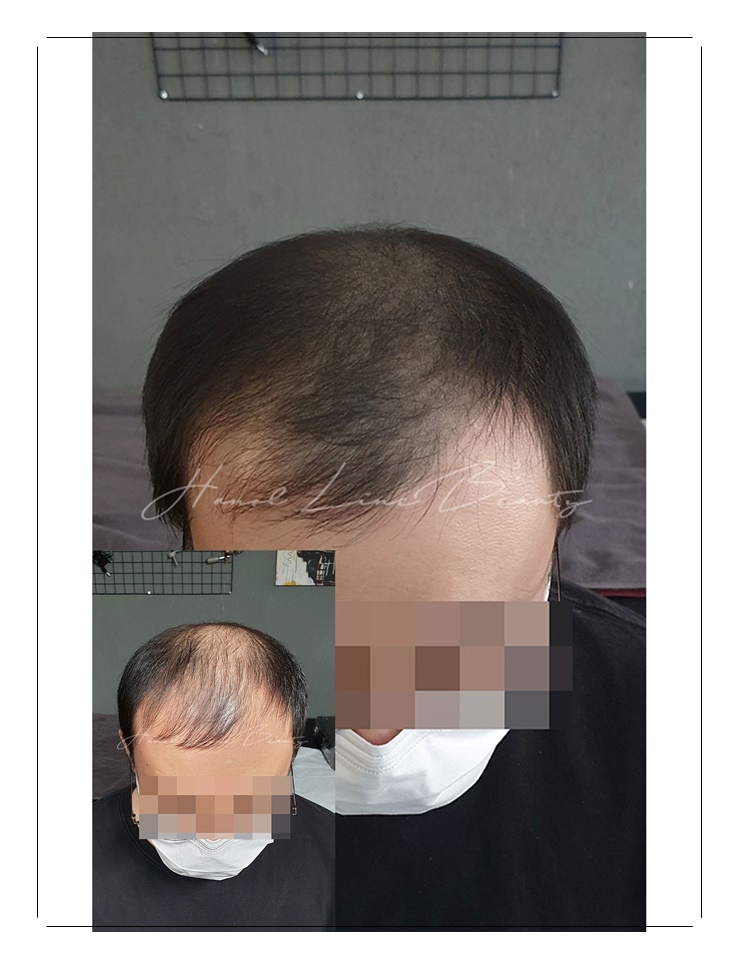 정수리두피문신