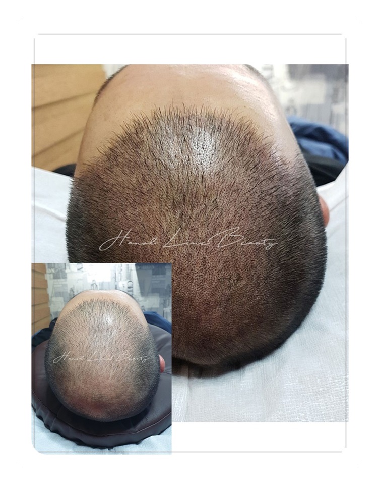 일산두피문신