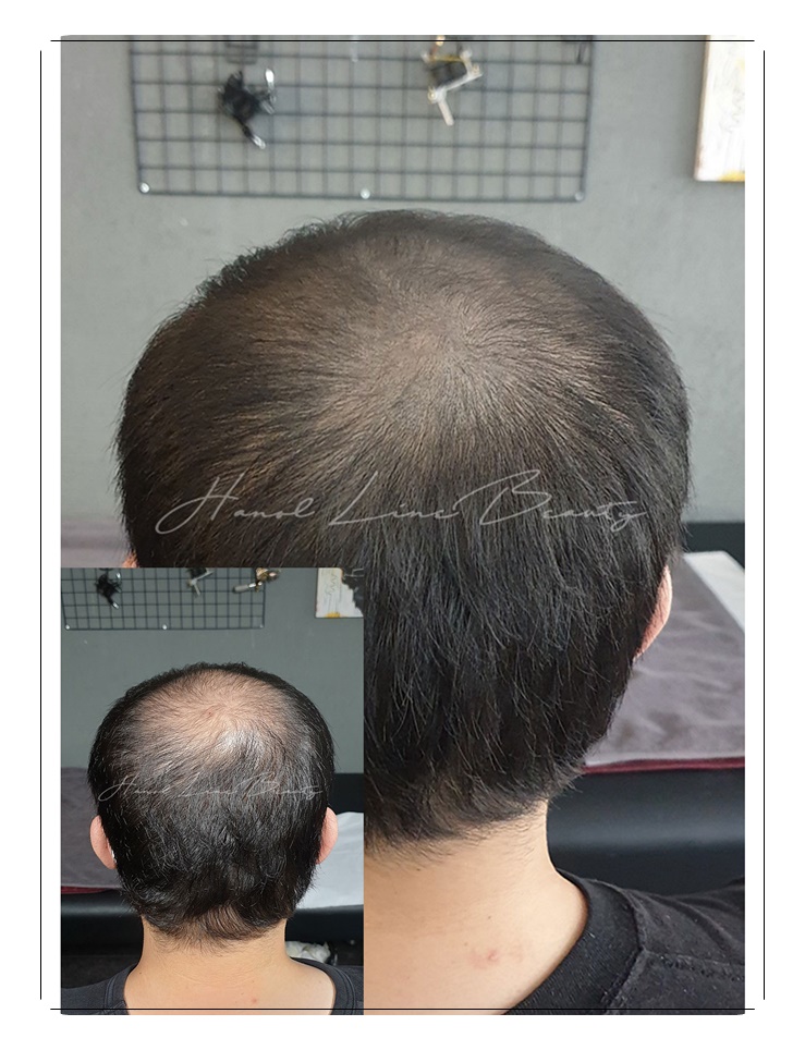 일산smp두피문신