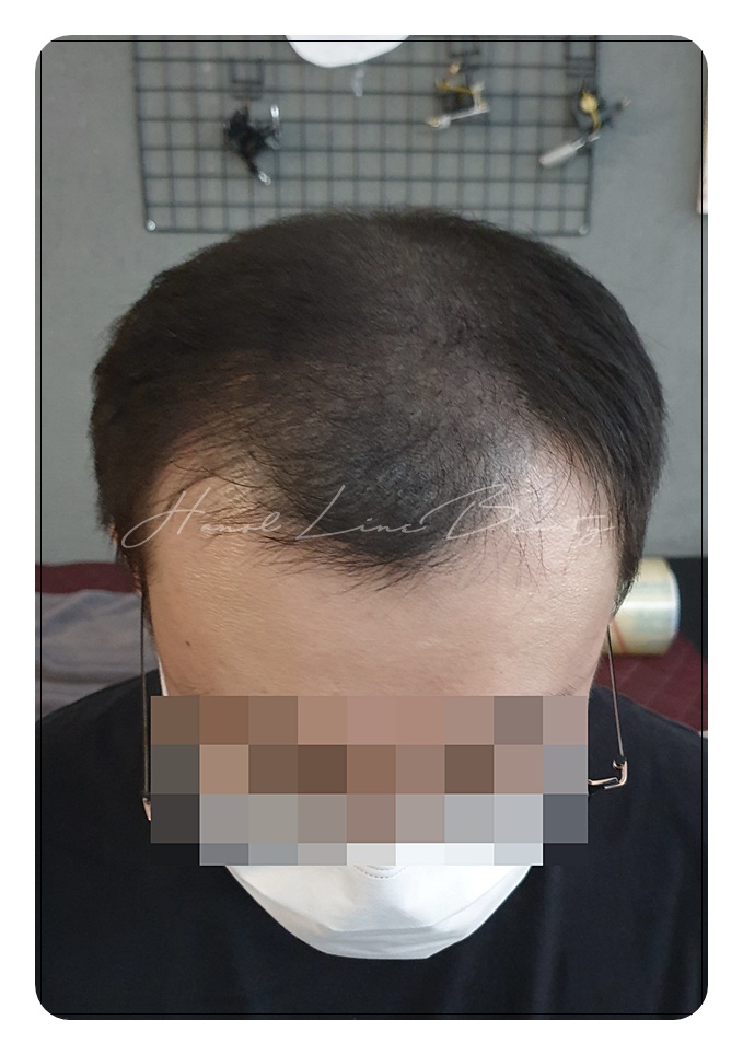 대머리문신