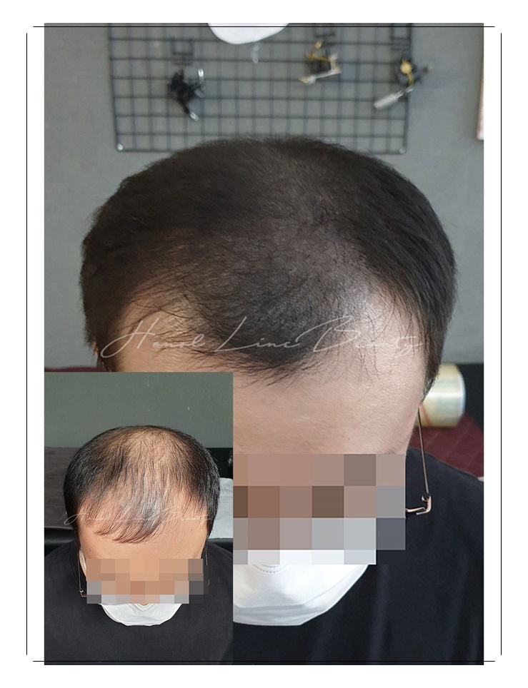 정발산두피문신