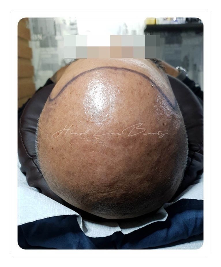 김포두피문신