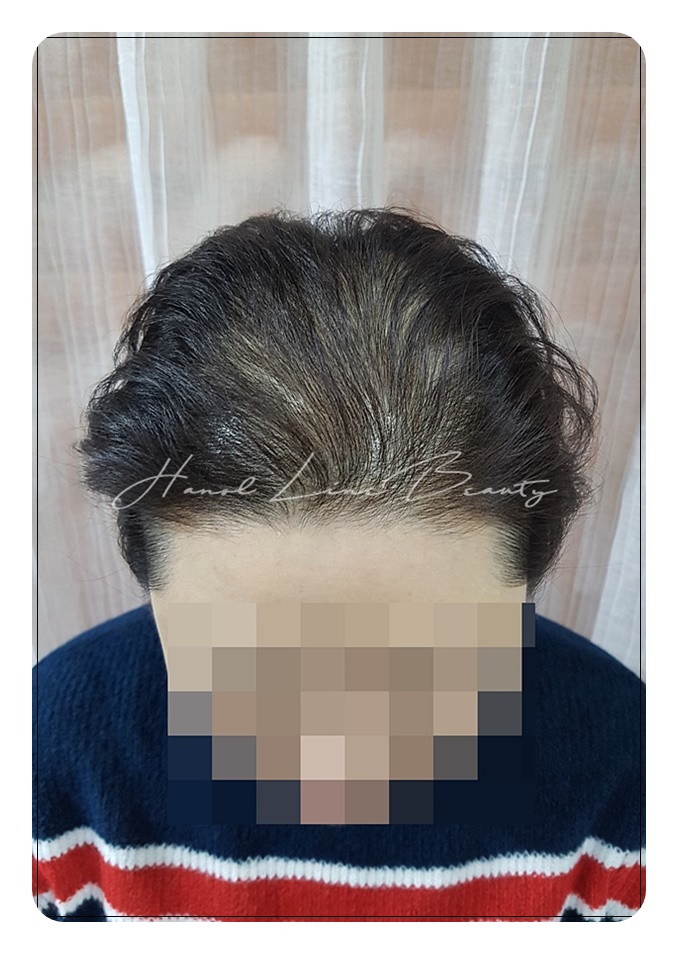 김포두피문신