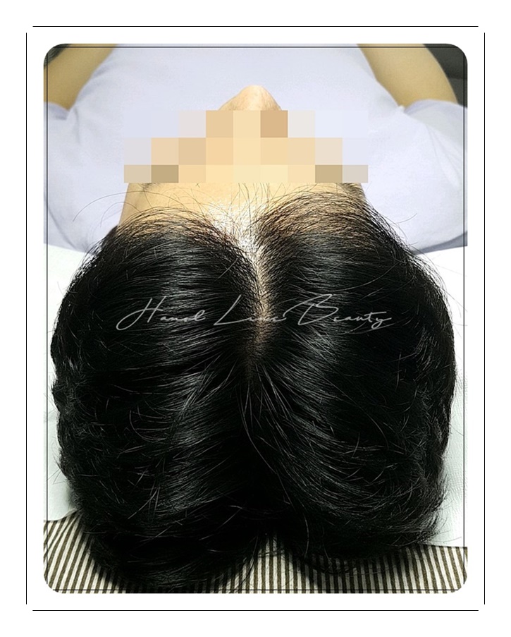 목동두피문신
