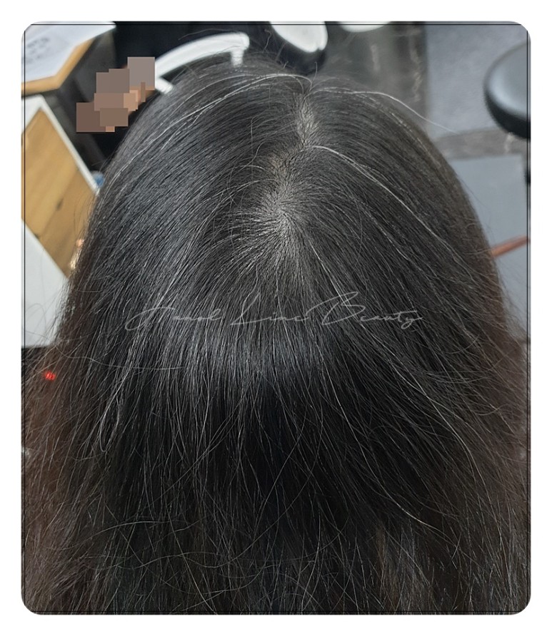 인천두피문신