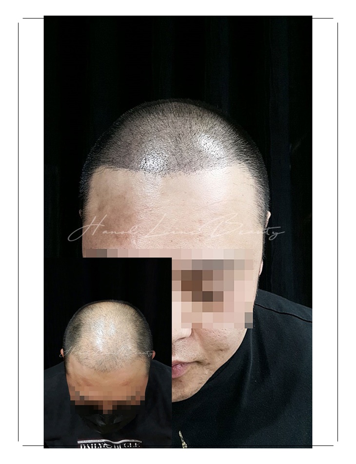 일산두피문신