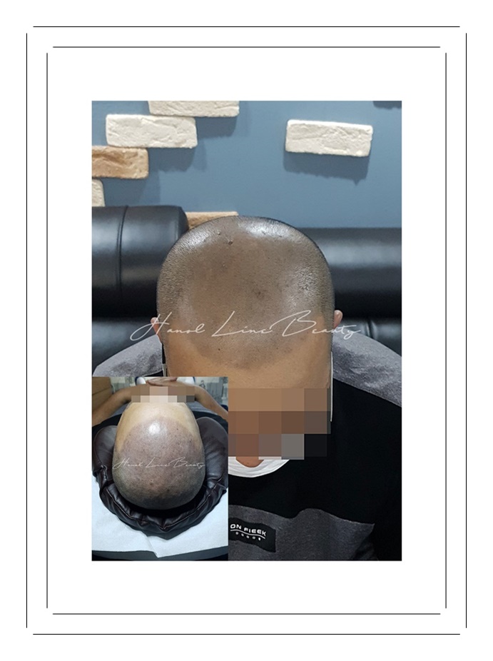 여성두피문신