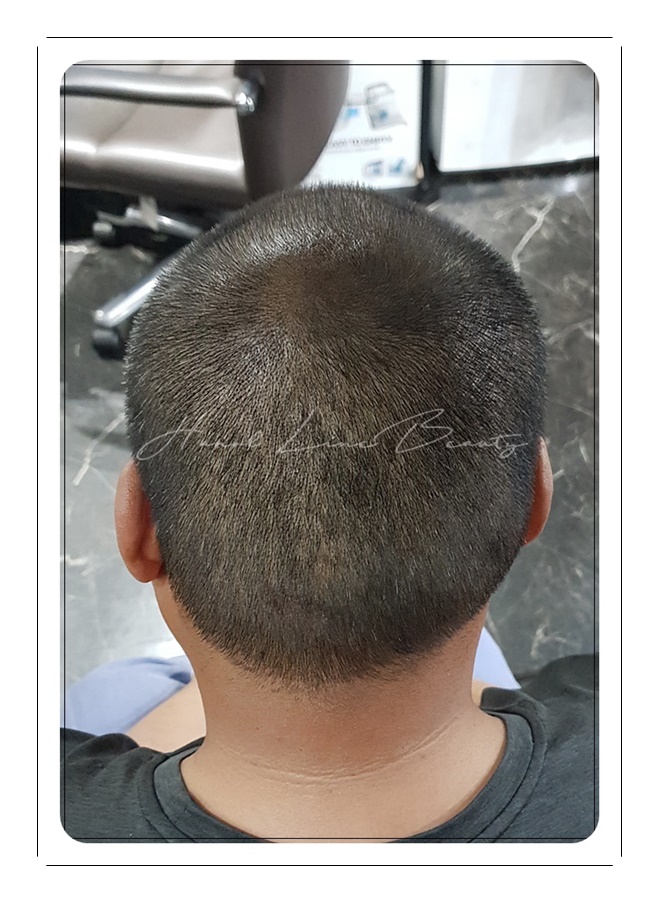 두피문신잘하는곳