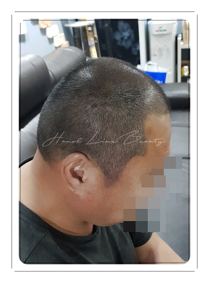 목동두피문신