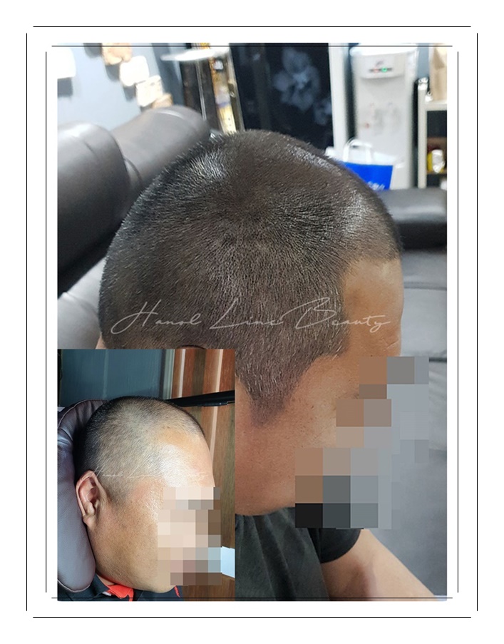 압구정두피문신
