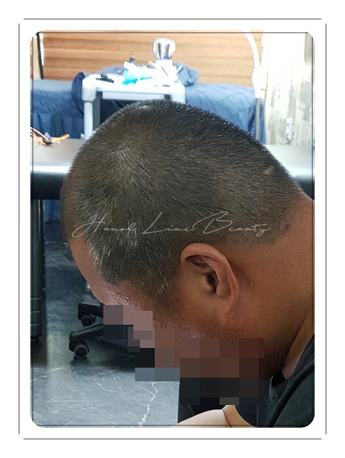 강남두피문신
